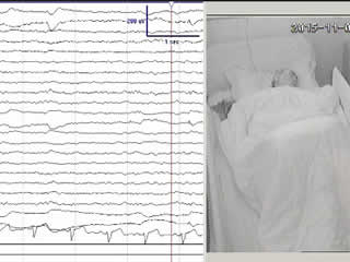 Sleep-related hypermotor epilepsy activated by rapid eye movement sleep