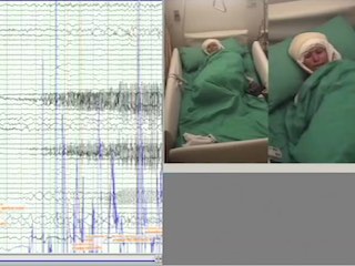 Ictal spitting in non-dominant temporal lobe epilepsy: an anatomo-electrophysiological correlation