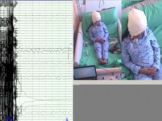 Ictal spitting in non-dominant temporal lobe epilepsy: an anatomo-electrophysiological correlation