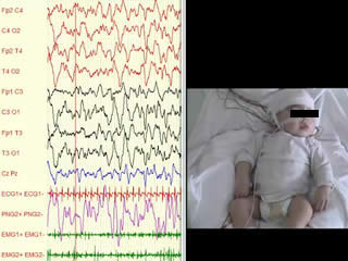 Neonatal tremor episodes and hyperekplexia-like presentation at onset in a child with SCN8A developmental and epileptic encephalopathy
