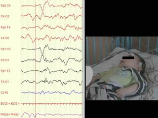 Neonatal tremor episodes and hyperekplexia-like presentation at onset in a child with SCN8A developmental and epileptic encephalopathy