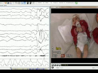 Epileptic encephalopathy with microcephaly in a patient with asparagine synthetase deficiency: a video-EEG report