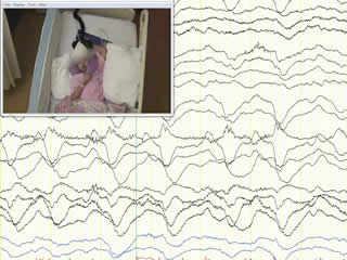 LGI-1 antibody encephalitis in a seven-year-old girl