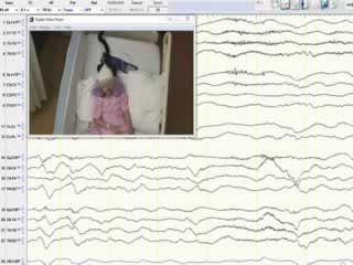 LGI-1 antibody encephalitis in a seven-year-old girl