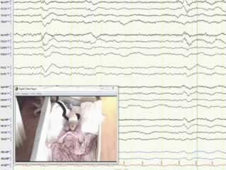 LGI-1 antibody encephalitis in a seven-year-old girl