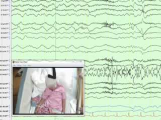 LGI-1 antibody encephalitis in a seven-year-old girl