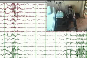 Ictal asystole with intercurrent cardiopathy: a complex combination  leading to delayed diagnosis