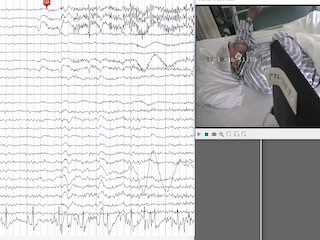 EEG source estimation in a rare patient with cold-induced reflex epilepsy