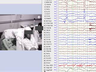 Syncope due to ictal asystole: a challenging semiology