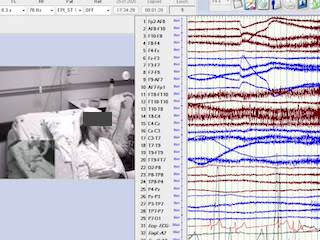 Syncope due to ictal asystole: a challenging semiology