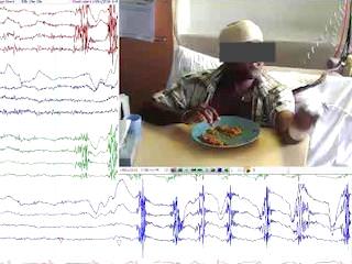 Seizures triggered by eating: a rare form of reflex epilepsy