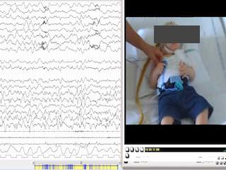 Description of a peculiar alternating ictal electroclinical pattern in a young boy with a novel SPATA5 mutation