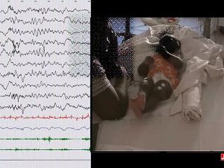 How to distinguish seizures from non-epileptic manifestations