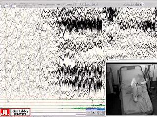 How to distinguish seizures from non-epileptic manifestations