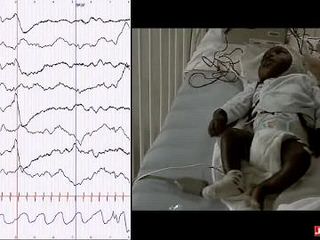 How to distinguish seizures from non-epileptic manifestations