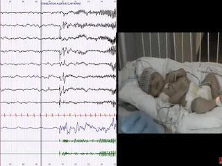 How to distinguish seizures from non-epileptic manifestations