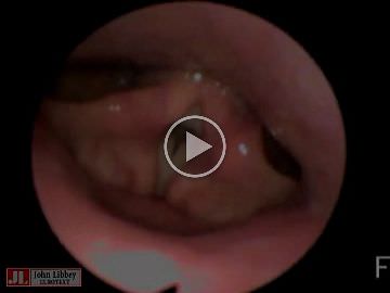 Clinical management of voice and breathing problems in two patients with vagus nerve stimulation therapy