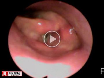 Clinical management of voice and breathing problems in two patients with vagus nerve stimulation therapy