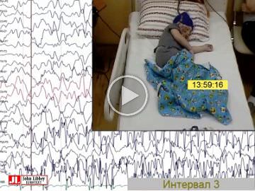 <I>STXBP1</I> germline mutation and focal cortical dysplasia