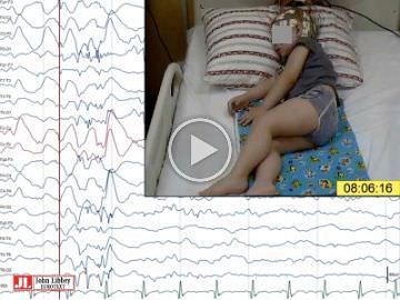 <I>STXBP1</I> germline mutation and focal cortical dysplasia