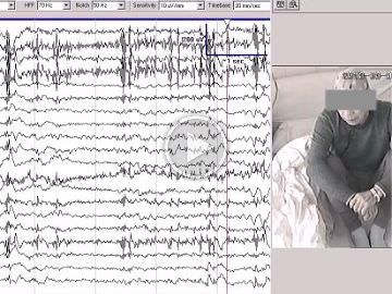 Characteristics of visual sensitivity in familial cortical myoclonic tremor and epilepsy