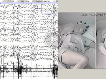 Characteristics of visual sensitivity in familial cortical myoclonic tremor and epilepsy