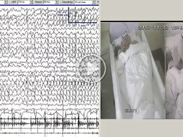 Characteristics of visual sensitivity in familial cortical myoclonic tremor and epilepsy