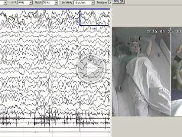 Characteristics of visual sensitivity in familial cortical myoclonic tremor and epilepsy