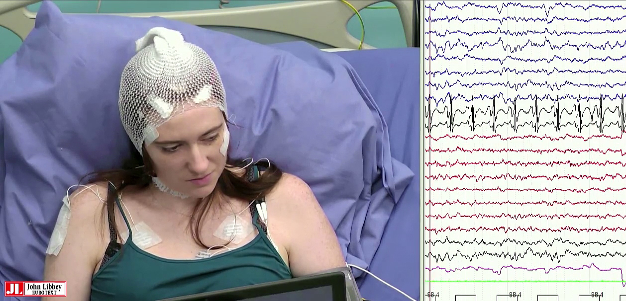 Musicogenic epilepsy with ictal asystole: a video-EEG case report