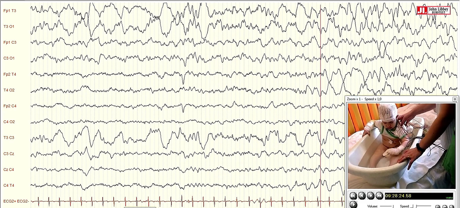 Bathing epilepsy: a video case report