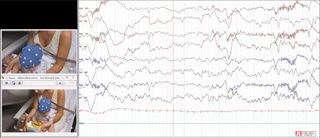 Benign spasms of infancy or benign myoclonus of early infancy: polygraph-EEG recordings