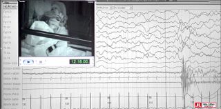 Benign spasms of infancy or benign myoclonus of early infancy: polygraph-EEG recordings