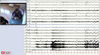 Low-grade tumour over the left temporal neocortex and ictal asystole: network and surgical implications