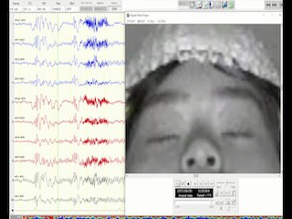 Eyelid myoclonia with absences related to epileptic negative myoclonus