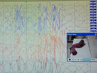 Auditory and emotion-sensitive jerks in a patient with subacute sclerosing panencephalitis