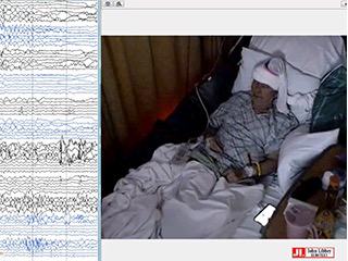 Ictal head roll: a seizure semiology from the anterior prefrontal lobe