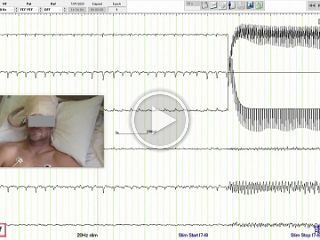 Localisation and stimulation of the parietal eye field