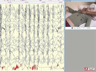 Epilepsy with myoclonic absences: a case series highlighting clinical heterogeneity and surgical management