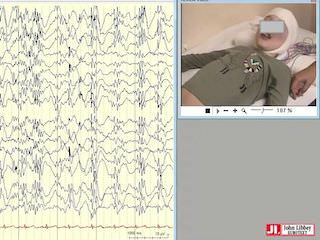 Epilepsy with myoclonic absences: a case series highlighting clinical heterogeneity and surgical management