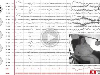 Autoimmune musicogenic bilateral temporal lobe epilepsy