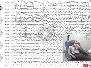 Autoimmune musicogenic bilateral temporal lobe epilepsy