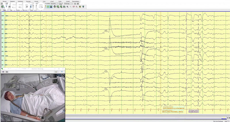 Tardive myoclonic focal seizures after electroconvulsive therapy, lithium and bupropion treatment