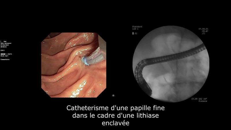 Cathétérisme d’une petite papille avec sphinctérotome de 3,9 French et d’un fil-guide de 0,025 inch