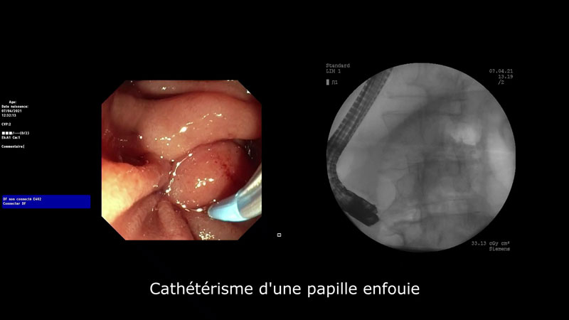 Cathétérisme d’une papille enfouie