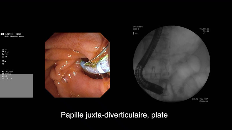 Cathétérisme d’une papille juxta-diverticulaire, technique du double fil-guide et de la précoupe sur fil-guide pancréatique