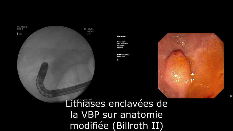 Cathétérisme de la papille avec « inversion » du sphinctérotome dans le cas d’un montage chirurgical Billroth 2