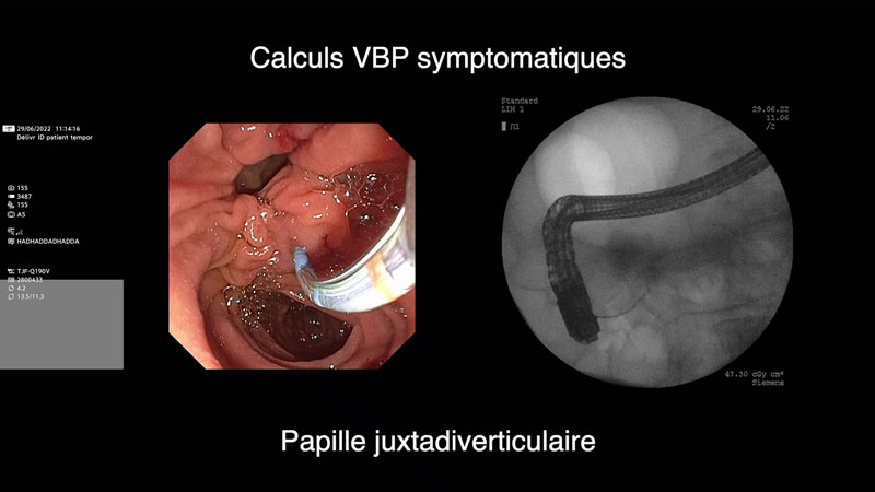 Cathétérisme de la papille : technique de la pré-coupe sur fil-guide pancréatique (papille juxta-diverticulaire)