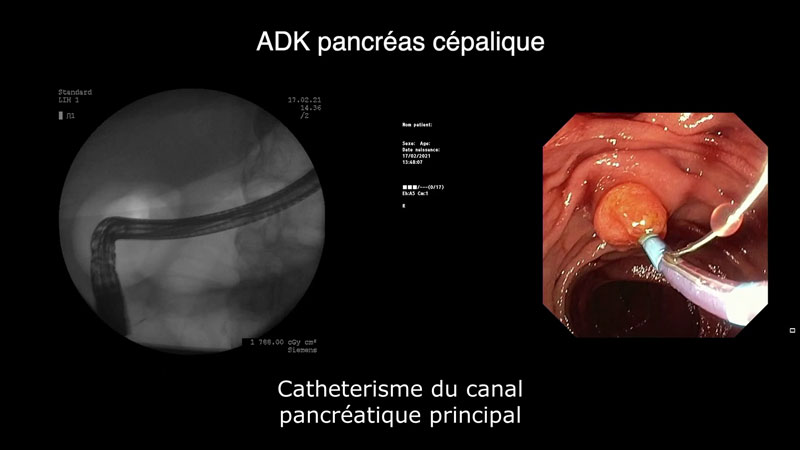 Cathétérisme de la papille : technique de la pré-coupe sur fil-guide pancréatique