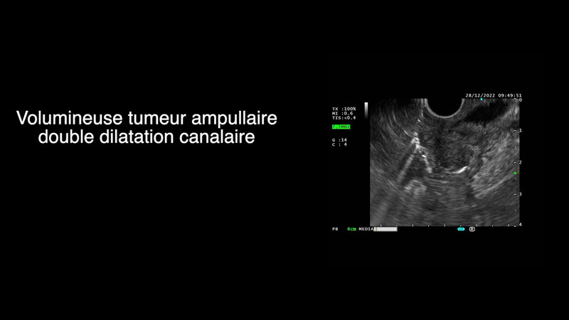 Infundibulotomie ou fistulotomie