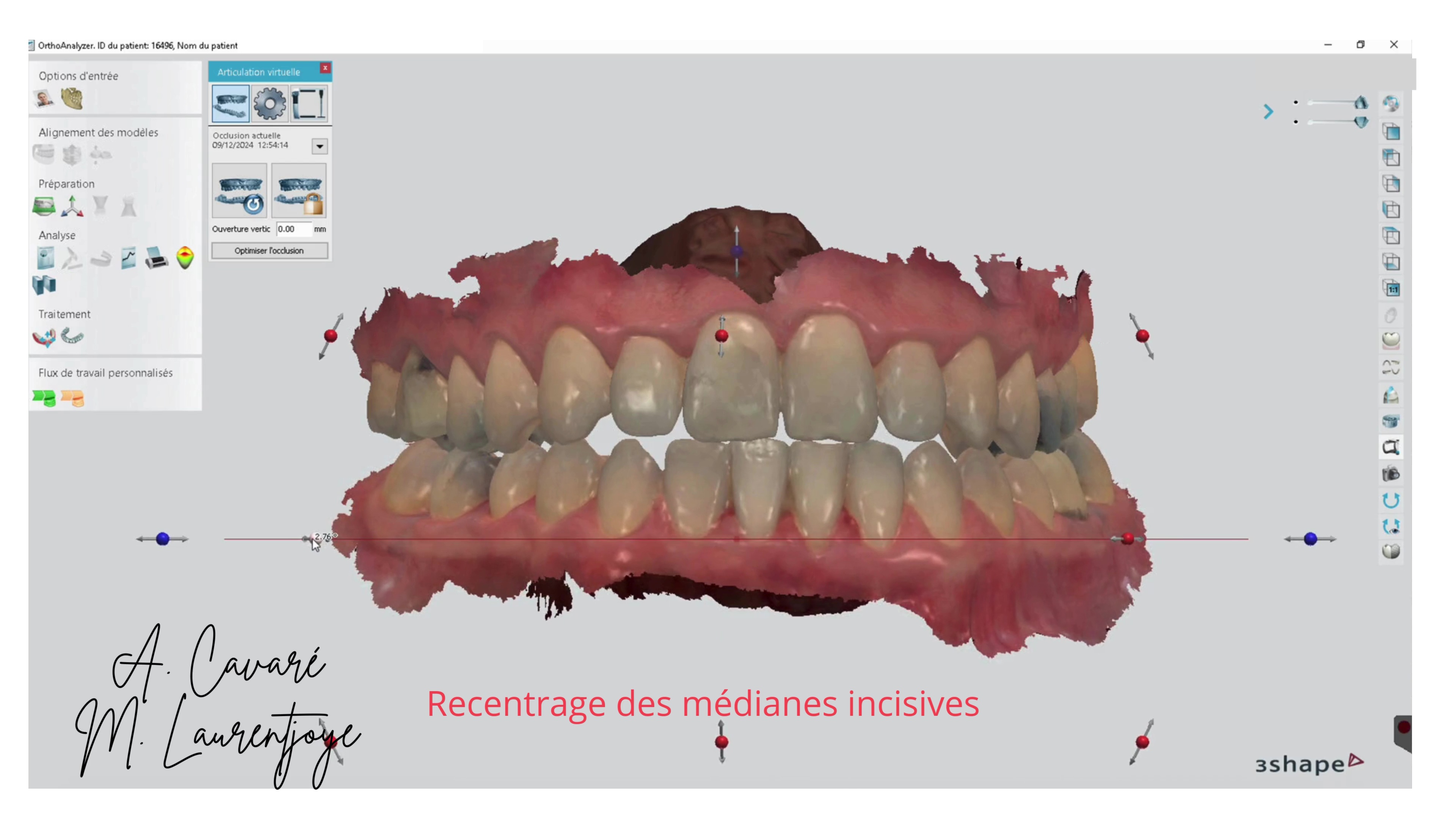 Optimisons la planification virtuelle de nos patients ortho-chirurgicaux autour du concept de « bloc occlusal »